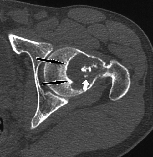 Chondroma: How To Manage It - Science Reflex